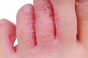 tinea