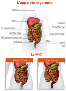 MICI