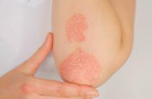 La Psoriasi: Un Approccio Olistico tra Dieta e Rimedi Naturali