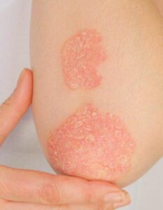 La Psoriasi: Un Approccio Olistico tra Dieta e Rimedi Naturali