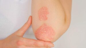 La Psoriasi: Un Approccio Olistico tra Dieta e Rimedi Naturali