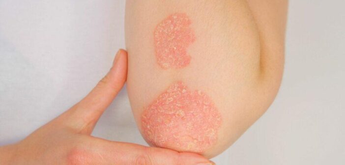 La Psoriasi: Un Approccio Olistico tra Dieta e Rimedi Naturali