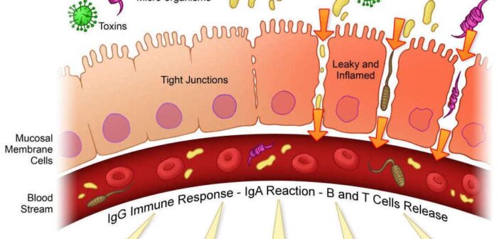 Cos’è la Permeabilità Intestinale (Leaky Gut) e Come Trattarla