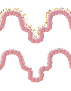 Disbiosi Intestinale: Quando i Batteri Sbagliati Prendono il Sopravvento